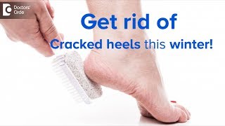 Treat deep cracked heels | Get rid of Cracked heels this winter! - Dr. Rasya Dixit | Doctors