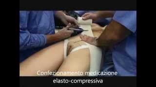 LIFTING COSCE - DOTT. DOMENICO RIITANO - video 003