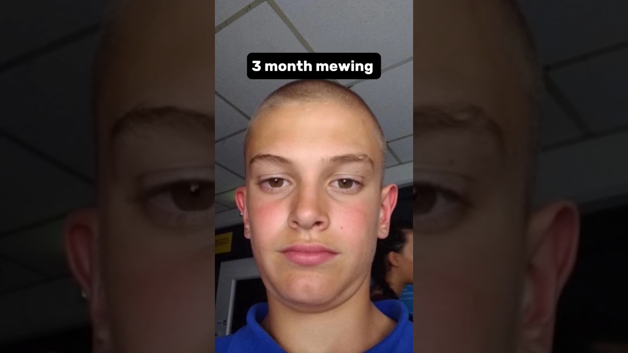 3 months mewing transformation 🔥