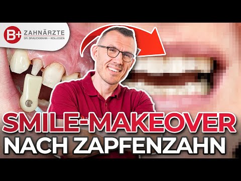 Zahnkronen und Veneers // Smile Makeover im Oberkiefer mit Zapfenzahn