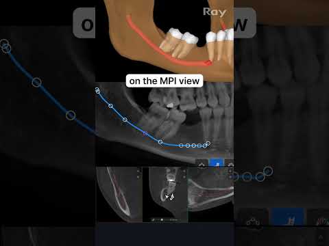 SMARTDent : 5D Tutorial #2-5. Edit the Auto Nerve Canal