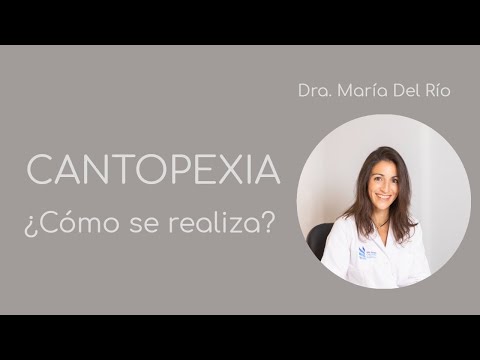Cantopexia – Técnica Quirúrgica