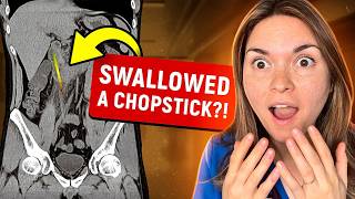 Most BIZARRE Objects SWALLOWED: Doctor Reacts