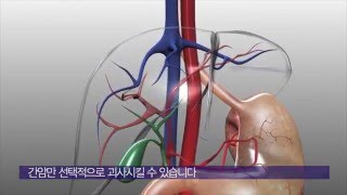 간<b>동맥</b> 화학색전술 방법 미리보기 썸네일