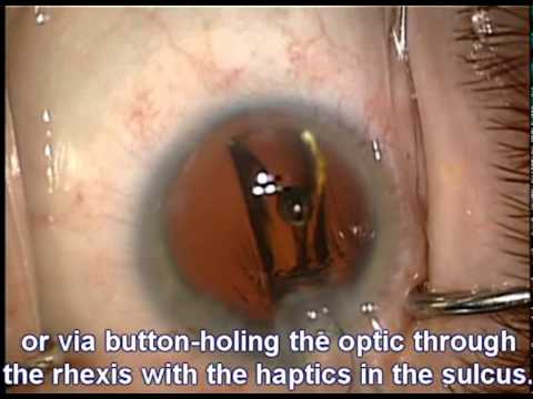 Cataract Surgery Preceded By Vitrectomy