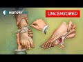 Medical History Amputations In The Battlefield