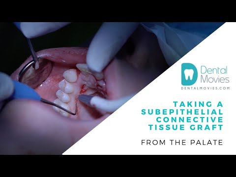 Taking a subepithelial connective tissue graft from the palate