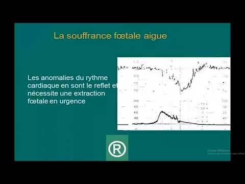 Iv Conférence nationale sur lhypertension pulmonaire Le traitement de lhypertension chez les patients souffrant dinsuffisance rénale chronique