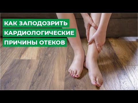 Как заподозрить кардиологические причины отеков?