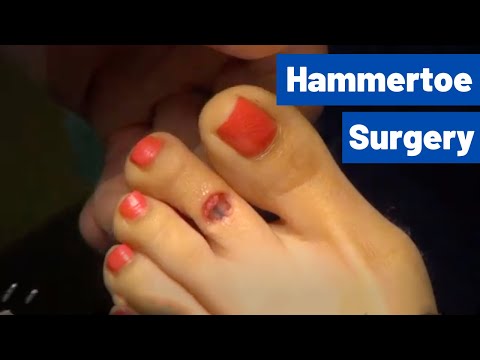 Cosmetic Toe Shortening Long Toe Surgery Video Without Metal Pins