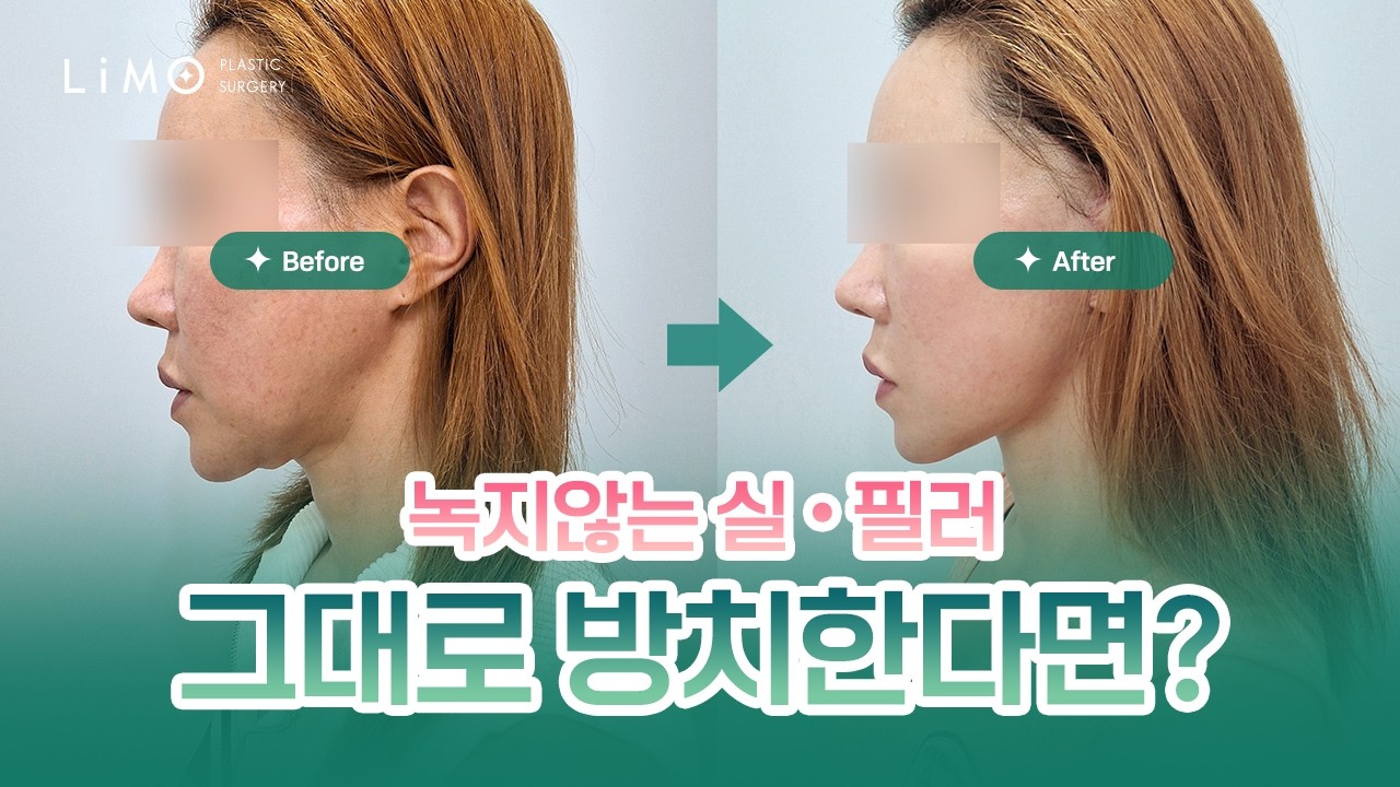 리모성형외과 유튜브 영상
