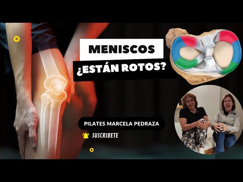 MENISCOS ¿ESTÁN ROTOS?