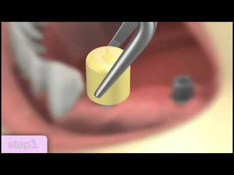 Dental_implants_procedure_video - restoration