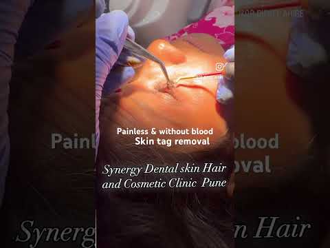 Painless Skin Tag Removal | Dr. Dipali Dambal