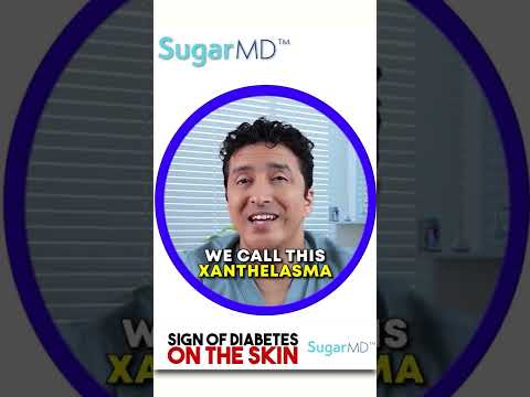 Xanthelasma | Sign of Diabetes on The Skin