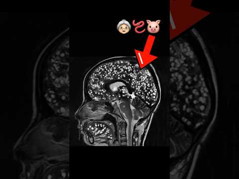 , title : 'Tapeworm INFESTED Grandma’s Brain, Here’s What Happened Next… #medical #parasite'