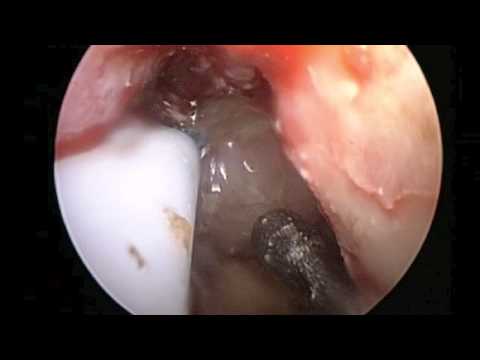 Transnasal Endoscopic Approach to the Pituitary Using an Ultrasonic Aspirator