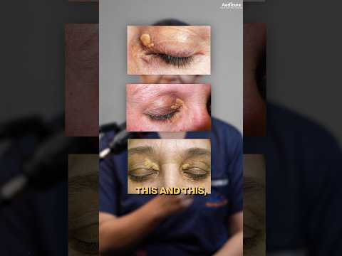 Yellow Patches Around Eyes? Get Your Cholesterol Checked! #yelloweyes #eyes #eyecare