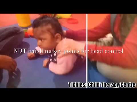 Neurodevelopment Treatment (NDT) for Dystonic Cerebral Palsy