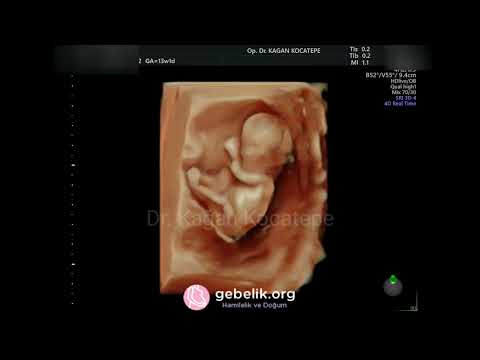 10 haftalık gebelikte rahim içindeki kan birikimi (hematom) kendiliğinden nasıl yok olur? Riskli mi?