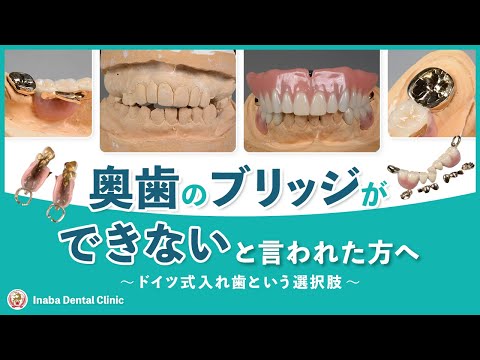 奥歯のブリッジができないと言われた方へ〜ドイツ式入れ歯という選択肢〜