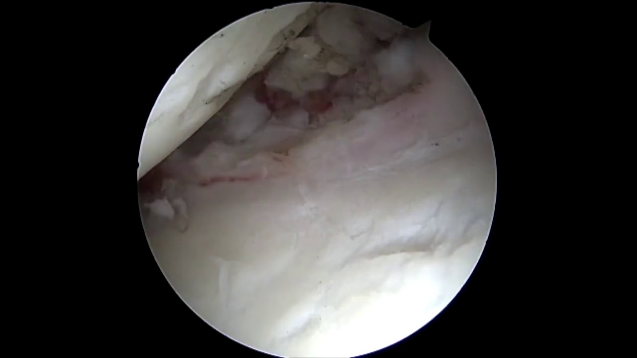 Dr. Garcia demonstrates his release technique for frozen shoulder