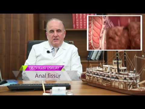 Op. Dr. Kadir Uskuay - Genel Cerrahi Uzmanı - Anal Fissür
