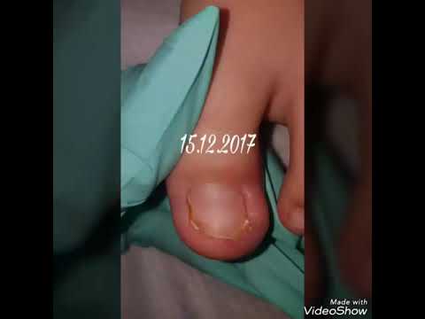 Rețetele bunicii pentru tratamentul ciupercii unghiilor de la picioare