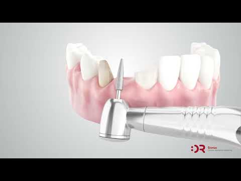 Zubni most | Cijena i ugradnja | Štimac centar dentalne medicine | Zubni mostovi | Stomatološka poliklinika Zagreb | Štimac centar dentalne medicine