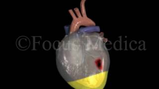 Pericardial effusion - Heart