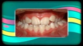 preview picture of video 'Fort Morgan Orthodontist 970.542.2500'