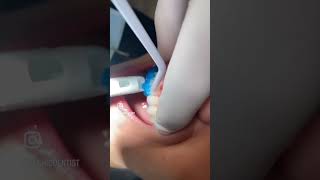 Square Peg Teeth