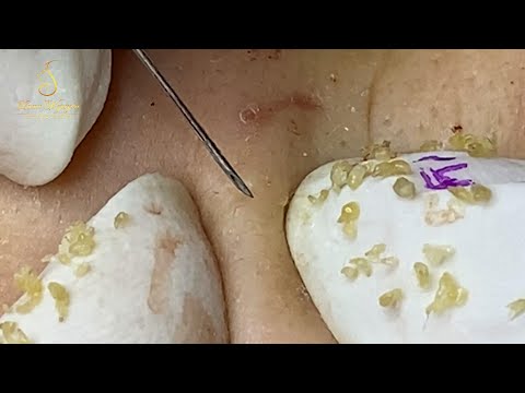 Loan Nguyen Acne Treatment (#112)
