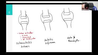 1.Daño articular: Osteoartritis o Artrosis (OA) Artritis infecciosa Gota y Pseudogota