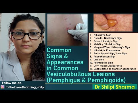 Signs in common Vesiculobullous Lesions (Pemphigus & Pemphigoids)