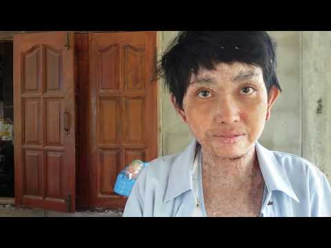 Neurodermatitis จำกัด ภาพถ่ายการรักษา โรคกระดูกพรุนในโรคสะเก็ดเงิน