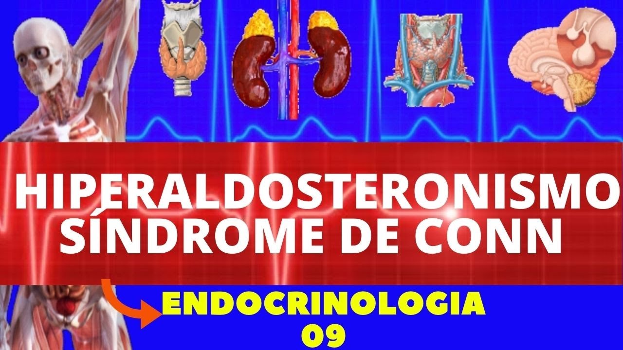 HIPERALDOSTERONISMO (SÍNDROME DE CONN) - ENDOCRINOLOGIA