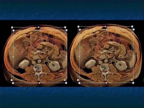 CT Evaluation of Small Bowel Tumors: Detection & Classification - Part 2