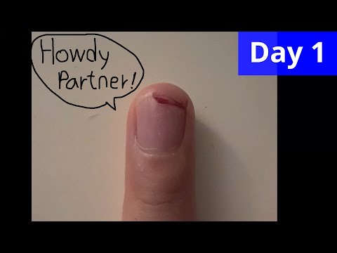 Finger nail recovery time lapse