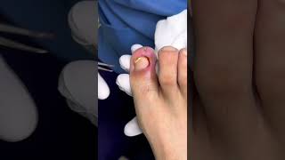 La uña perfora la piel 🥺