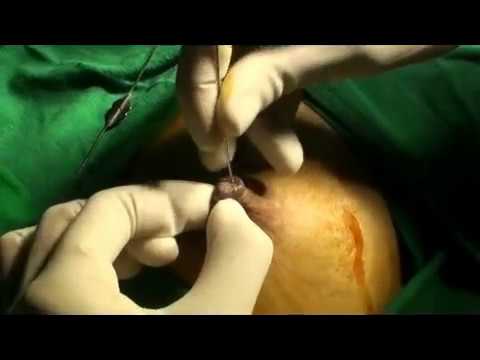 Virus papiloma humano cervix