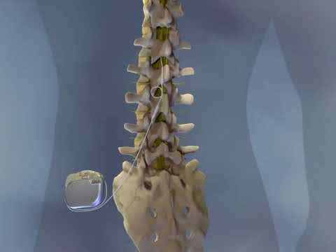 Dr. Georgios Matis - Neuromodulation - Spinal Cord Stimulation - Instructional video - Background