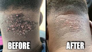 The Best Way to Get Rid of Razor Bumps (My Barber