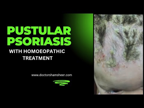 Pustular Psoriasis