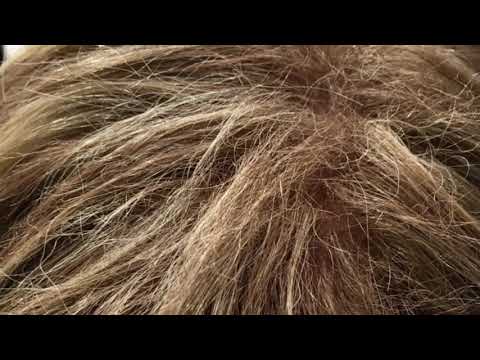 Alopecia og paryk mod skaldethed