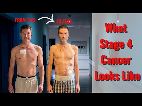 The Devastating Effects Of Stage 4 Cancer