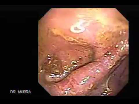 Cum sunt cauterizate verucile genitale ale vaginului
