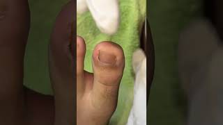 Ep_8175 Ingrown toenail removal 👣 เคลียร์เสร็จแล้ว..แตกต่างจากก่อนทำไหม 😄 (clip from Thailand)