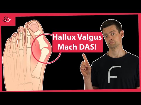 Hallux Valgus loswerden - Diesen Fehler macht jeder!
