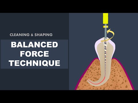 Balanced Force Technique | Cleaning and Shaping